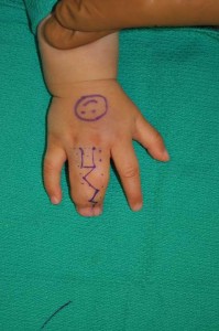Syndactyly-surgical-plan1