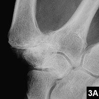 Thumb base arthritis and trapeziectomy